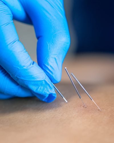 Close up of a needle and hands of physiotherapist doing a dry needling in a physiotherapy center.